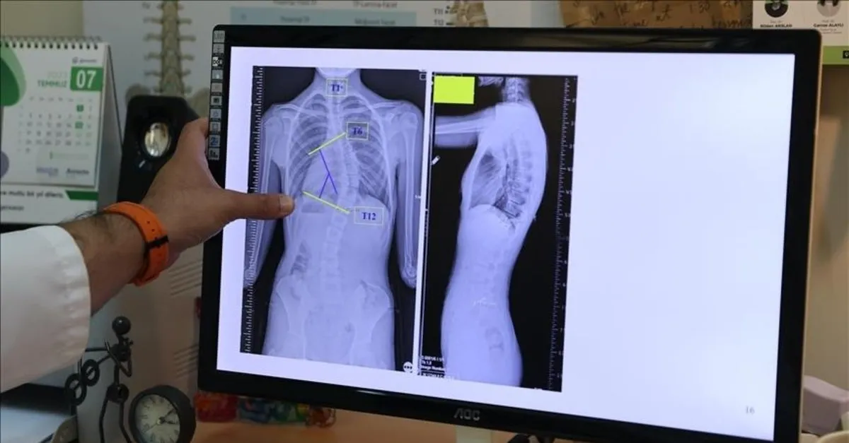 Skolyozda Erken Tanının Önemi: Uzmanlardan Ailelere Kritik Uyarılar